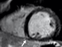 MRI shows late gadolinium enhancement (LGE) at the right ventricular attachment (arrow) of a 19-year-old male. Image courtesy of RSNA