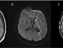 Stroke seen in a 41-year-old male patient with COVID-19 infection. Image courtesy of RSNA