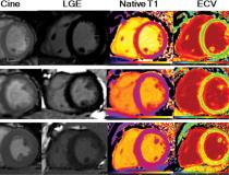 LGE images, native T1 maps, extracellular volume maps, and global longitudinal strain (GLS) show myocardial abnormalities in adults recovering from moderate and severe COVID-19. Image courtesy of RSNA
