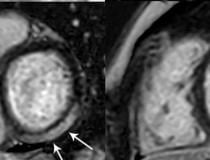 MRI shows prominent LGE involving more than 50% of the myocardium in the basal inferolateral and inferior segments of the left ventricle. Image courtesy of RSNA