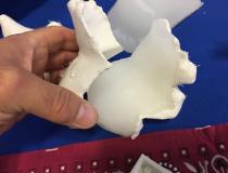 The University of Texas Southwest uses a 3-D printing lab to custom build radiotherapy boluses for specific patients. This example is a silicone bolus for cancer in the jaw. They 3-D printed the mold from the patient CT scan.