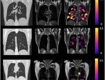 CT, proton (1H), and proton and RBC:TP imaging from post-hospitalized COVID patients. There is minimal damage on cT, and yet highly heterogeneous and low RBC:TP in the lungs of post-hospitalized COVID-19 patients. Image courtesy of Grist JT et al., published online in Radiology on May 24, 2022.