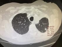 Lung cancer nodules with measurements called up as one of the options in Philips Oncology Navigator software demonstrated at ASTRO 2021.
