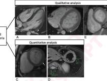 Qualitative and quantitative cardiac MRI T2-based criteria for myocarditis in patients caused by a recent COVID-19 mRNA vaccination. Qualitative criterion was focal myocardial edema and is shown on 4-chamber precontrast SSFP image (arrow) in 16-year-old male (A) and 17-year-old male (B). Quantitative criteria included T2 parametric mapping and quantification of myocardial signal intensity ratios. Focal subepicardial edema of the basilar left ventricular inferior wall (arrow) is shown on source image from T2