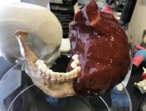 Example of life-like 3D printed tumor that is incorporated into a patient's jaw bone from Materialise. The vendor's software is FDA-cleared for use to print anatomy from CT or MRI studies that will be the exact size as the patient's actual anatomy. This can be used for planning and practicing complex surgical or interventional procedures and the model can aid navigation during procedures. 