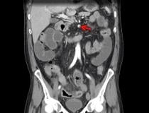 Superior mesenteric artery thrombosis (Red arrow) complicated by bowel ischemia and perforation in a 54-year-old man who presented to the emergency department with abdominal pain and was diagnosed with COVID-19. Contrast-enhanced CT images of the abdomen and pelvis show mucosal hyperenhancement involving the small bowel.