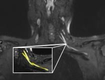 An MR image of a patient in their early 20s shows nerve injury (highlighted in yellow) of the left brachial plexus in the neck. The patient experienced left arm weakness and pain after recovering from COVID-19 respiratory illness, which prompted them to see their primary care physician. As a result of the MRI findings, the patient was referred to the COVID-19 neurology clinic for treatment. Image courtesy of Northwestern University #COVID19 #COVID #SARSCoV2