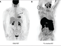 According to an open-access article in ARRS’ American Journal of Roentgenology (AJR), increased axillary lymph node or ipsilateral deltoid uptake is occasionally observed on FDG or 11C-choline PET performed after Pfizer-BioNTech or Moderna COVID-19 vaccination