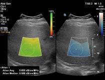 Philips Healthcare Epiq Ultrasound GI Liver
