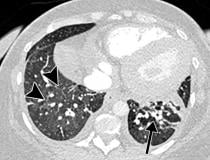 COVID-19 caused pulmonary edema in a 50-year-old woman with a history of end-stage renal disease who underwent hemodialysis and who was admitted to the hospital for hypoxia and pneumonia. Axial contrast-enhanced chest CT obtained after 1 month for persistent hypoxemia show pulmonary edema, increasing small bilateral pleural effusions, cardiomegaly, prominent interlobular septal (arrowheads) and peribronchovascular (arrow) thickening, and diffuse ground-glass opacities. Pulmonary edema superimposed on COVID