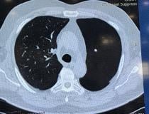 Example of Riverain's pulmonary artery vessel suppression artificial intelligence application for CT. It can automatically remove pulmonary vessels the system to just show lung nodules that the AI had determined are not cross sectional views of vessels. 
