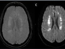 Acute anterior cerebral artery/middle cerebral artery watershed infarction seen in a 47-year-old male patient who presented with COVID-19 pneumonia. Image courtesy of RSNA