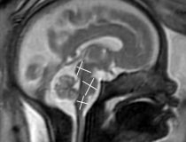 COVID-19 of mild to moderate severity in pregnant women appears to have no effect on the brain of the developing fetus, according to a study being presented today at the annual meeting of the Radiological Society of North America (RSNA).