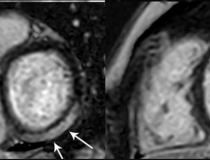 MRI shows Prominent LGE involving more than 50% of the myocardium in the basal inferolateral and inferior segments of the left ventricle and in the anterolateral, inferolateral, and inferior segments of the left ventricle at the midventricular level in adolescent female. Note: this image is for illustrative purposes only and is not associated with the Big Ten study group. Image courtesy of Radiology: Cardiothoracic Imaging.