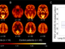 18F-FDG PET in patients with long-COVID syndrome. A and B: Transaxial sections of group averaged, spatially normalized 18F-FDG PET scans in patients with long-COVID syndrome (A) and control patients (B). C: The pattern expression score (PES; *adjusted for age and sex, for illustration purposes) of the previously established COVID-19-related spatial covariance pattern was not significantly different between patients with long-COVID syndrome and control patients. Boxplots (grey), as well as individual values 