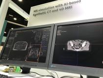 An example of a synthetic CT scan dataset created from an MRI dataset for use in radiotherapy treatment planning so an additional CT scan is not needed. This example is from Siemens Healthineers at the 2021 American Society of Radiation Oncology (ASTRO) meeting. The image on the left is the MRI image, and the image on the right is a synthetic CT created from the MRI dataset. A few vendors are showing this technology that allows use of MRI soft tissue imaging to created CTs to avoid extra scans.