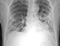 A lung digital radiography (DR) X-ray showing COVID-19 pneumonia in the lower lobes of the lungs.Image from Thirona and Delft Imaging.