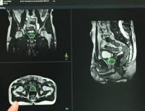 This is an example of the real-time MRI imaging of radiation therapy beam delivery on a liver tumor demonstrated with the Elekta Unity MRI-guided RT system at ASTRO 2019. It shows how real-time imaging can show organ/tumor motion due to respiration. Currently the radiation therapist can turn the beam off if the tumor moves out of tolerance, but the company is working toward automated beam off/on features to account for motion.
