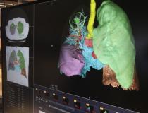 Ziosoft introduced a new lung nodule analysis application on its advanced visualization platform. 