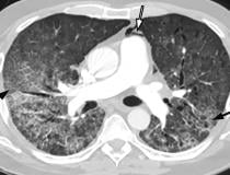 COVID-19 complicated by pneumomediastinum in a 61-year-old man. Axial chest CT angiographic images show a typical appearance of COVID-19 pneumonia, including diffuse GGOs and interlobular septal thickening (black arrows). Air is depicted anterior to the pulmonary artery (white arrow) and adjacent to the main pulmonary artery and left atrial appendage, indicative of pneumomediastinum. Image courtesy of Margarita Revzin et al. COVID in lungs