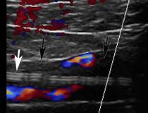 Deep vein thrombosis (DVT) associated with a peripherally inserted central catheter (PICC) line in a 54-year-old man with COVID-19. Sagittal color Doppler ultrasound image shows an echogenic thrombus (black arrows) in the right subclavian vein, associated with the PICC line (white arrow). Image courtesy of Margarita Revzin et al.  Clot caused by COVID
