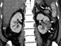 Example of kidney infarct organ damage caused by COVID-caused clotting in a 57-year-old man with COVID-19 who presented with abdominal pain. Image courtesy of Margarita Rezvin et al.  Read more on the trials examining the use of anticoagulation to treat COVID clotting.
