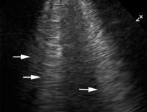 Lung ultrasound showing interstitial edema and pleural thickening in a 40-year-old man with COVID-19 who presented to the emergency department with hypoxia and dyspnea. Ultrasound image obtained in the longitudinal plane over the left lower lobe shows multiple (more than three) vertical echogenic bands (white arrows) extending from the pleural surface to the deeper portions of the lung, consistent with B-line artifacts, indicating subpleural interstitial edema. Note that the lung pleura is thickened and irr