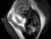 Two board-certified radiologists with several years of experience in fetal MRI evaluated MRI scans. They found that the brain development in the assessed areas was age-appropriate in all fetuses. There were no findings indicative of infection of the fetal brain.