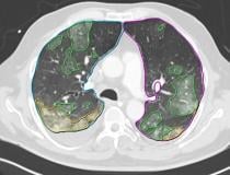 Artificial intelligence algorithm automatically identifies areas of COVID-19 pneumonia on a lung and quanfities the lesions without huamn intervention to help speed workflow. Several vendors developed COVID-19 specific AI algorithms in 2020, including Siemens and Philips. This is Philips' CT Pulmo Auto Results CT. The software performs automatic lung segmentation and lesion segmentation, together with classification of ground glass opacities/consolidation. Its automatically generated reports include volume.