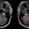 susceptibility-weighted imaging, SWI MR, SWI MRI, MRI Brain scan