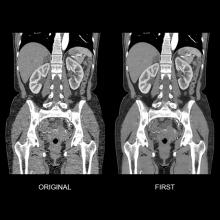iterative reconstruction
