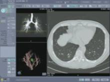 Lung CT Scan 