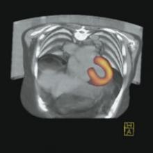 The Precedence SPECT/CT system from Philips Medical Systems