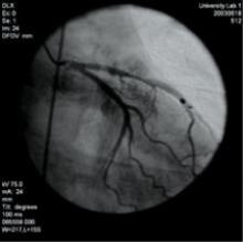 3-D volume rendering showing mid left anterior descending artery (LAD) stenosis, created using TeraRecon software