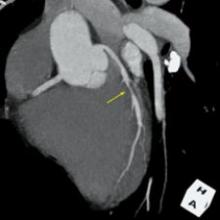 3-D volume rendering showing mid left anterior descending artery (LAD) stenosis, created using TeraRecon software.
