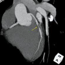 MR Angiography: Better Than CTA?