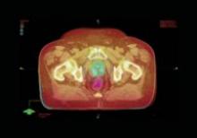 Who Sets the Curve for RT in Oncology?