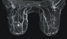 Sentillle Medical's Vanguard unit for breast MRI