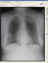 EDDA Technology offers IQQA-Chest software V2.0 featuring enterprise CAD solution for digital X-ray.