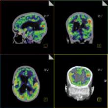 This image, acquired on Siemens' Biograph PET/CT, shows intracerebral metastases.