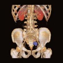 This image, acquired on Siemens' Biograph PET/CT, shows intracerebral metastases.