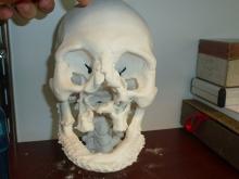  3-D printed model to guide face transplant