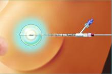 Brachytherapy Systems Women's Health Radiation Therapy