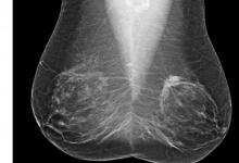 RSNA 2014, risk-based cancer screenings, mammography