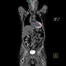 myocardial perfusion, PET/CT, Siemens, Biograph, mCT 