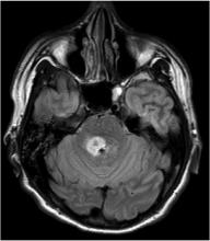 cerebral metastases, stereotactic radiosurgery, SRS, survival, AANS, Marshall