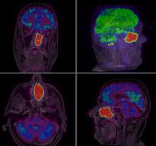 ependymoma, pediatric, radiotherapy, dose, ESTRO