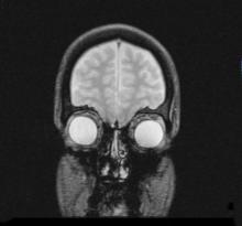 FDA says gadolinium retention in the brain is not a safety issue