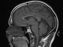 gadolinium, brain, contrast MRI, Radiology, Kanal, brain, brain MRI with contrast
