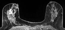 fibroglandular densities, dense breasts, breast cancer